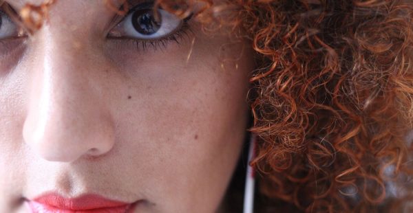 Redhead with Melasma