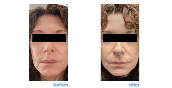 Radiofrequency Microneedling The Dermatology Specialists