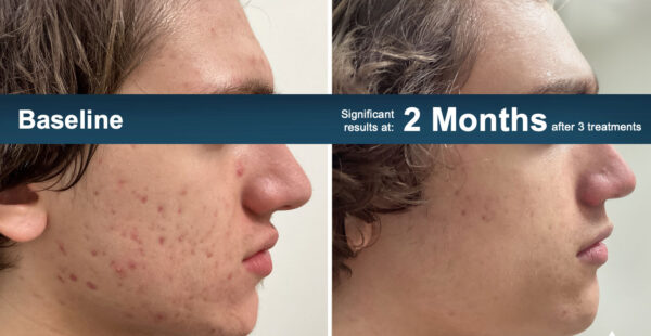 before and after accure laser treatment for acne