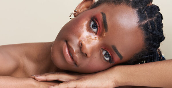 Illustration of skin affected by vitiligo, highlighting patches of depigmentation.