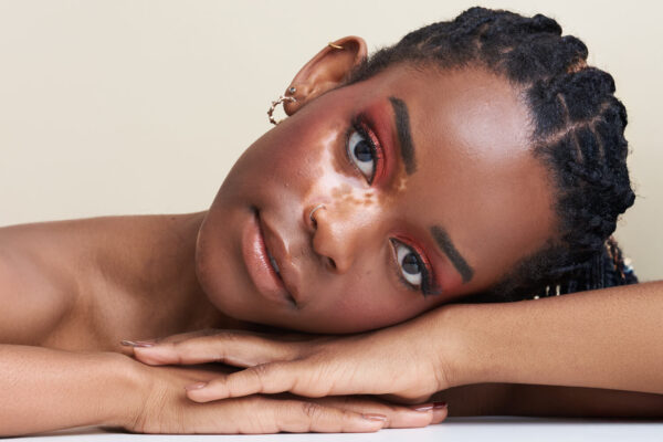 Illustration of skin affected by vitiligo, highlighting patches of depigmentation.