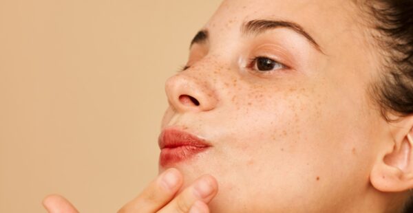Image of acne on chin and jawline