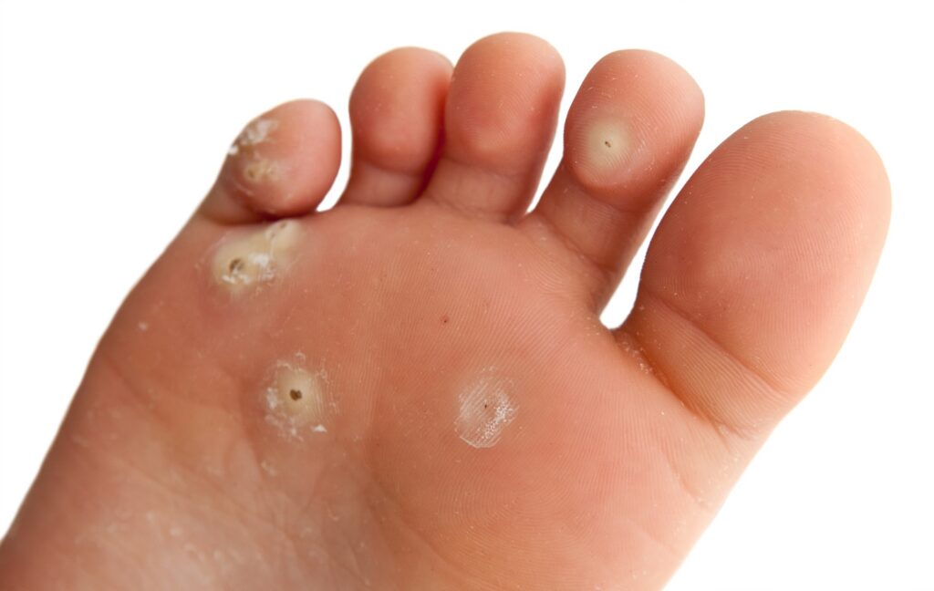 plantar wart on bottom of foot