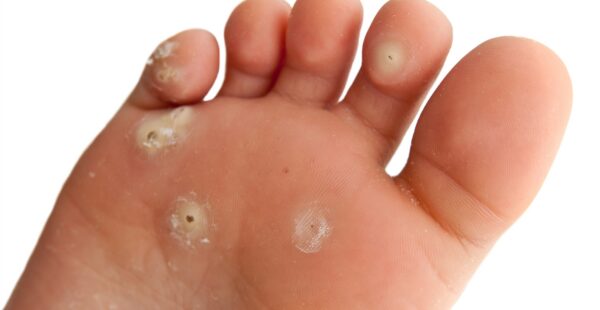 plantar wart on bottom of foot close-up
