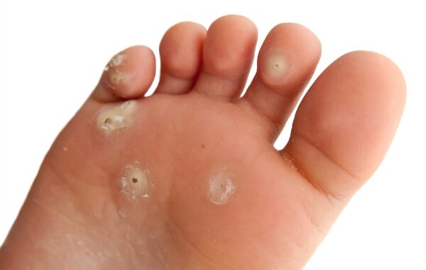 plantar wart on bottom of foot close-up