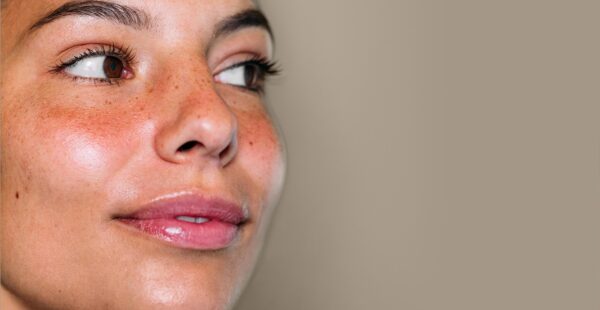 woman with rosacea
