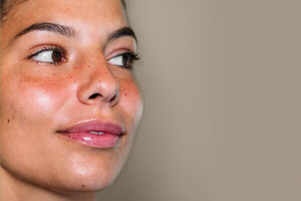 woman with rosacea
